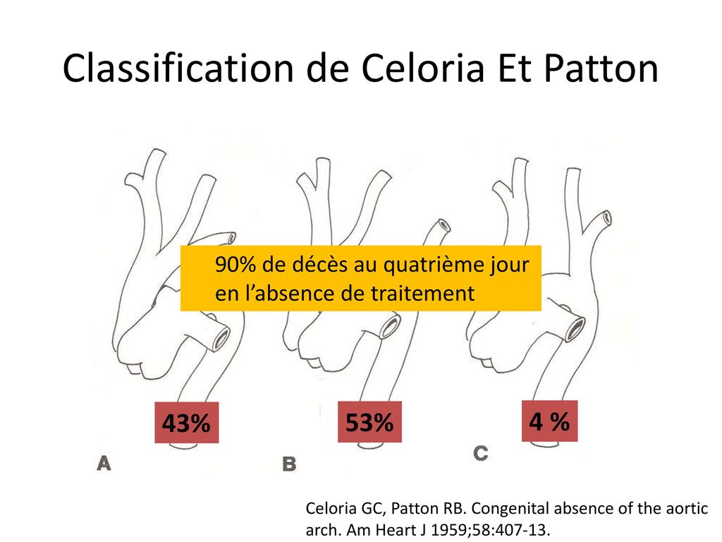 Interruption de l arche aortique r par e l ge adulte ppt